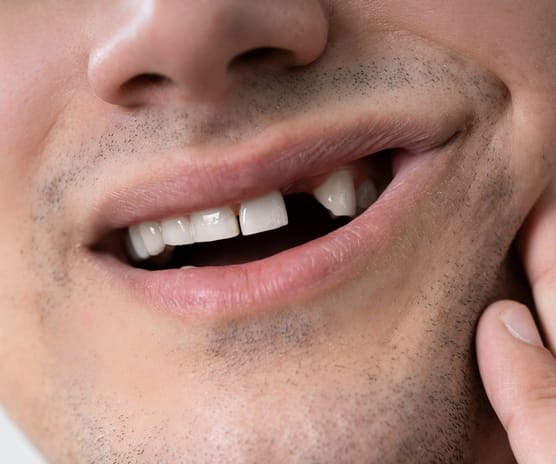 Broken or Knocked-Out Tooth
