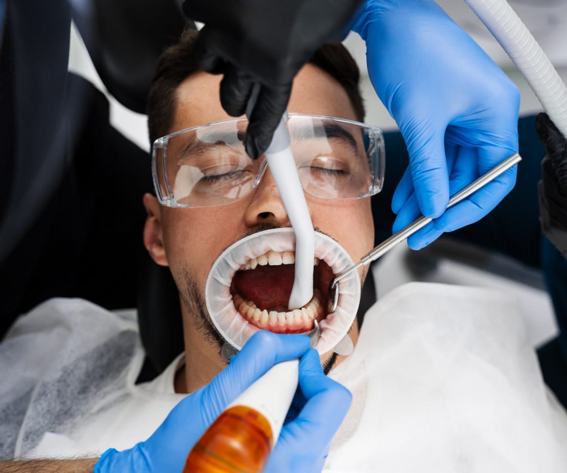 Cavity Fillings