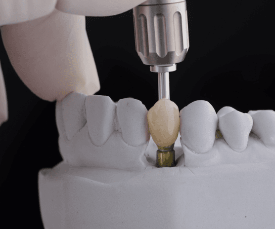 dental implant