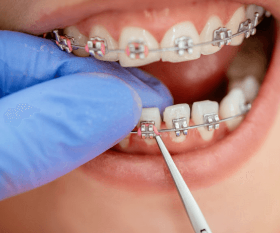 braces