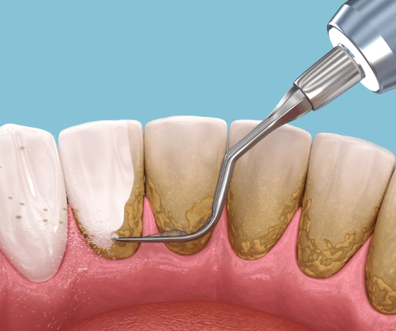 oral hygiene