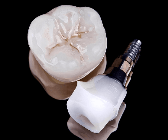 dental implant