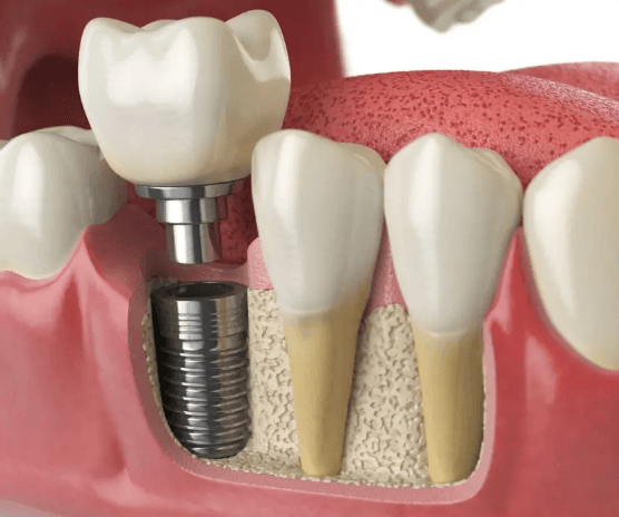 dental implant