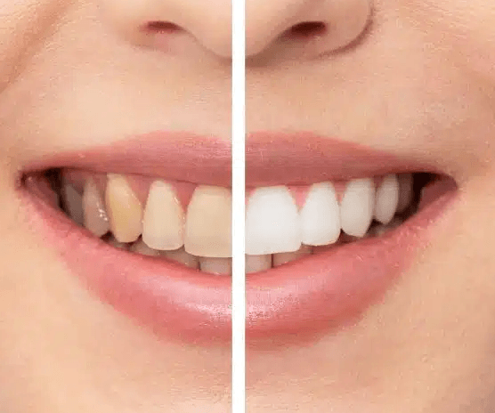 teeth whitening