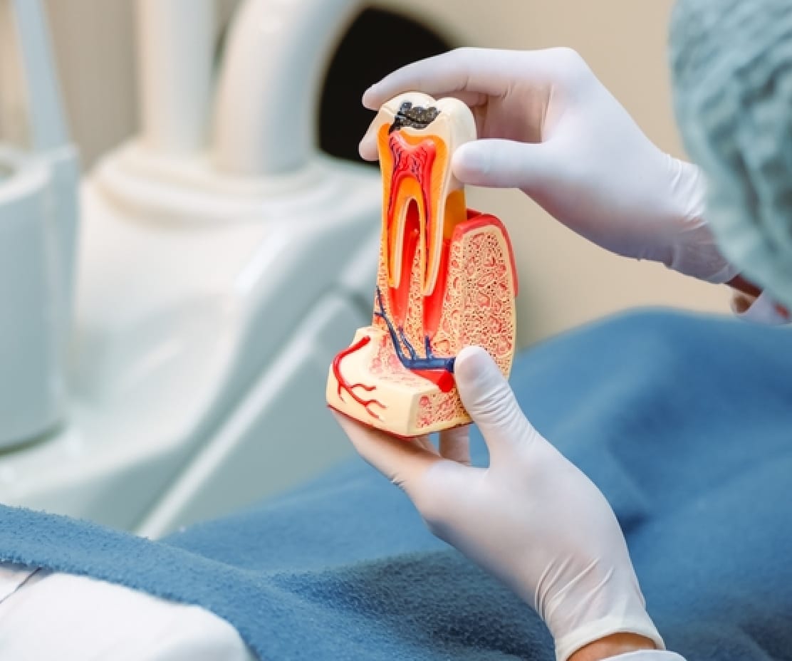 Root Canal Treatments