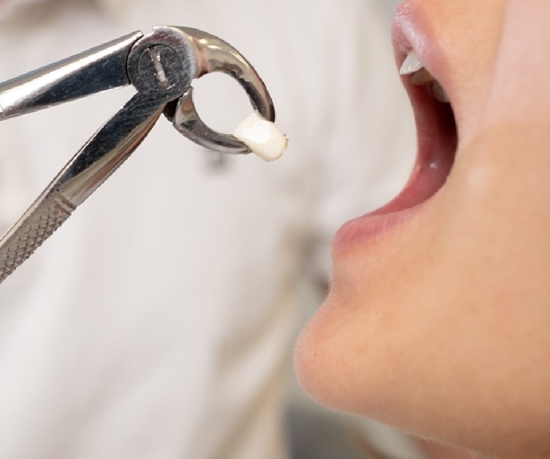 Tooth Extractions
